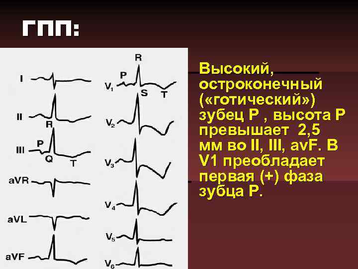 ГПП: Высокий, остроконечный ( «готический» ) зубец Р , высота Р превышает 2, 5