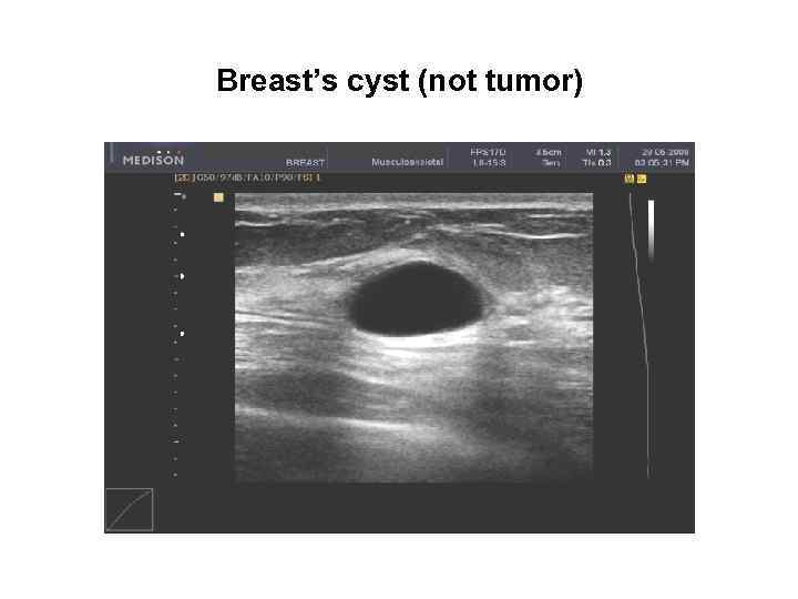 Breast’s cyst (not tumor) 