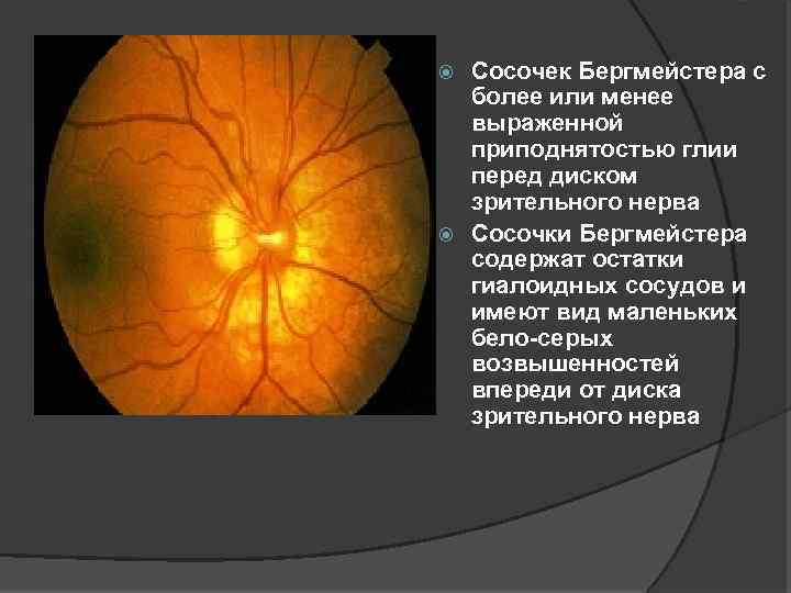 Сосочек Бергмейстера с более или менее выраженной приподнятостью глии перед диском зрительного нерва Сосочки