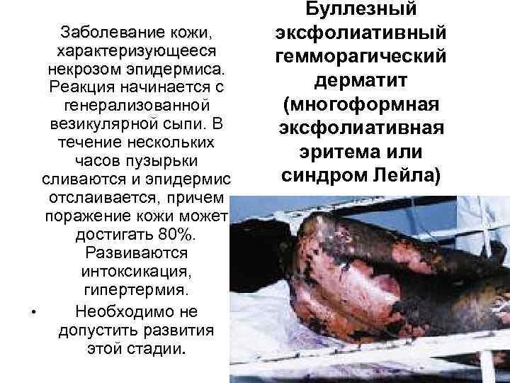 Заболевание кожи, характеризующееся некрозом эпидермиса. Реакция начинается с генерализованной везикулярной сыпи. В течение нескольких