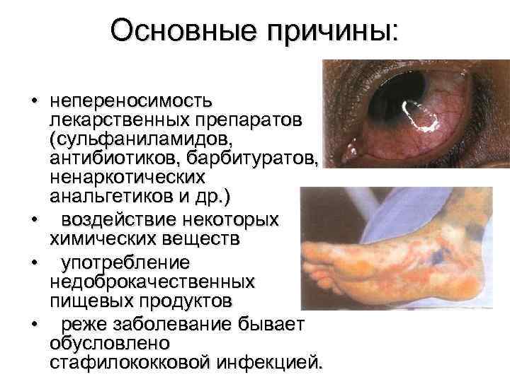 Основные причины: • непереносимость лекарственных препаратов (сульфаниламидов, антибиотиков, барбитуратов, ненаркотических анальгетиков и др. )