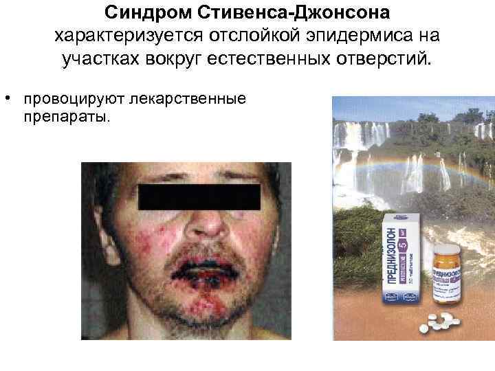 Синдром Стивенса-Джонсона характеризуется отслойкой эпидермиса на участках вокруг естественных отверстий. • провоцируют лекарственные препараты.