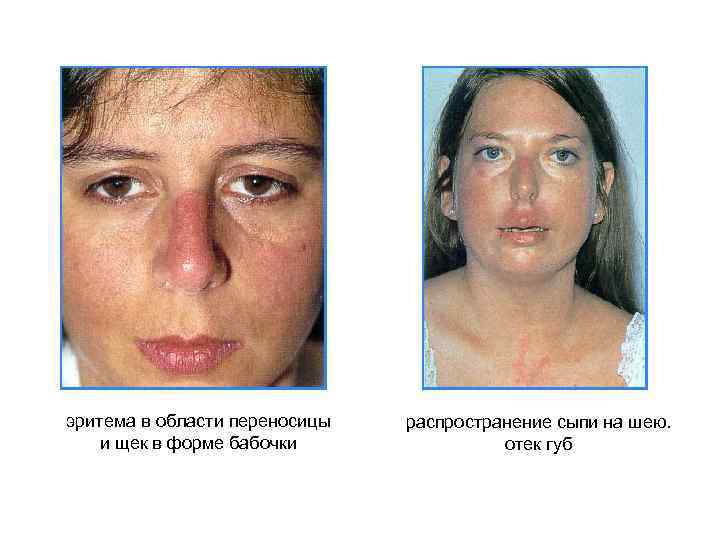 эритема в области переносицы и щек в форме бабочки распространение сыпи на шею. отек