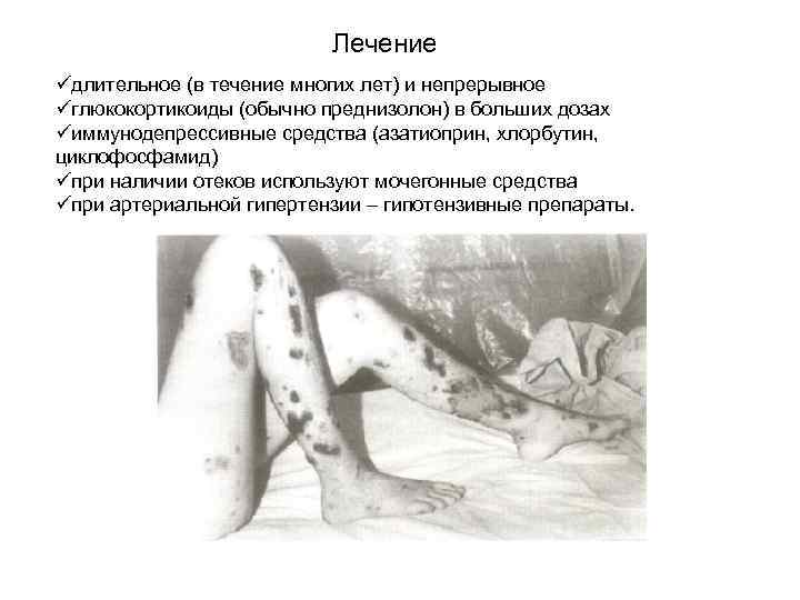 Лечение üдлительное (в течение многих лет) и непрерывное üглюкокортикоиды (обычно преднизолон) в больших дозах
