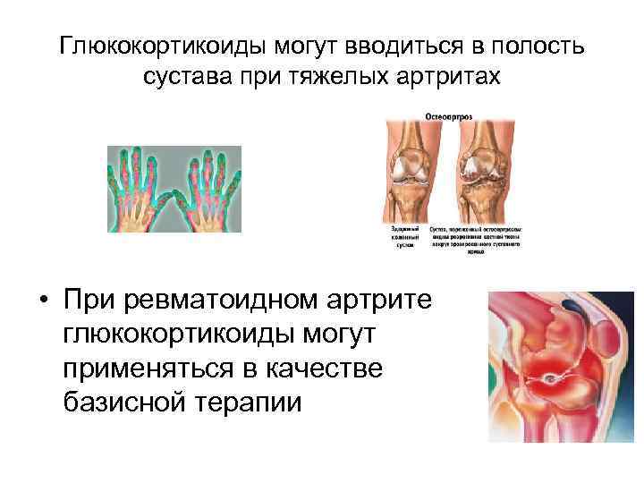 Глюкокортикоиды могут вводиться в полость сустава при тяжелых артритах • При ревматоидном артрите глюкокортикоиды