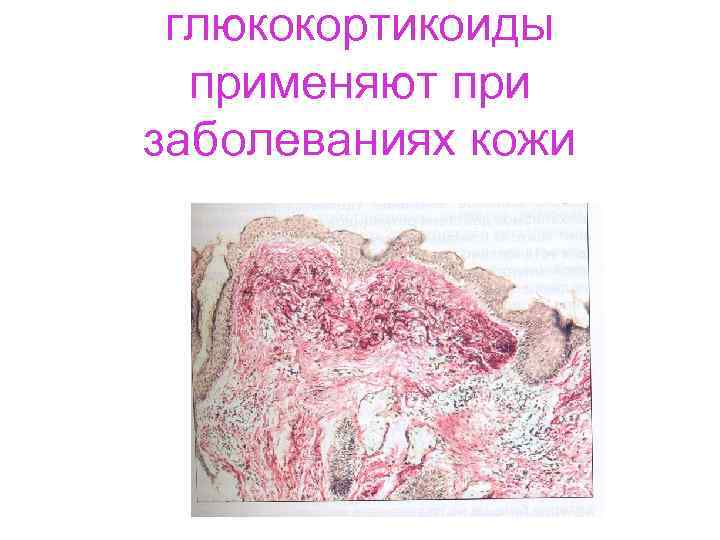  глюкокортикоиды применяют при заболеваниях кожи 