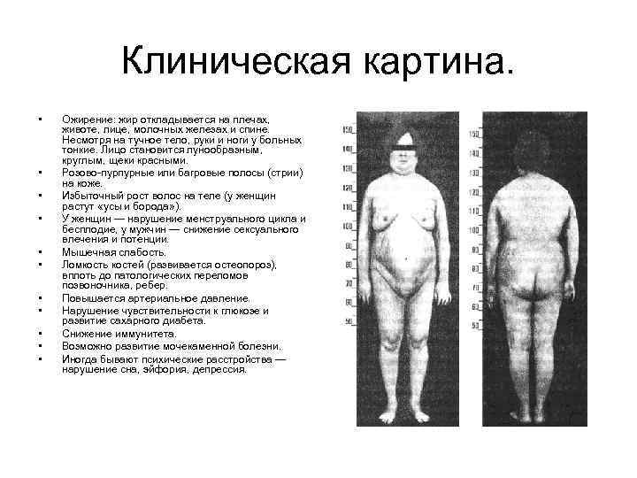 Клиническая картина. • • • Ожирение: жир откладывается на плечах, животе, лице, молочных железах