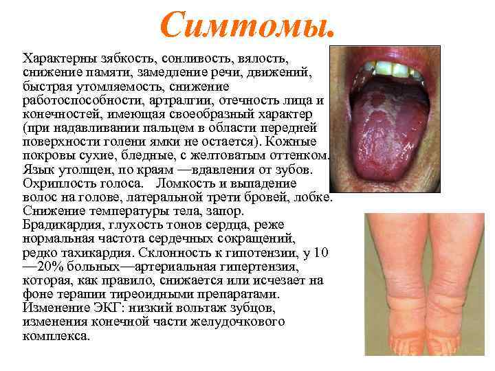 Симтомы. Характерны зябкость, сонливость, вялость, снижение памяти, замедление речи, движений, быстрая утомляемость, снижение работоспособности,