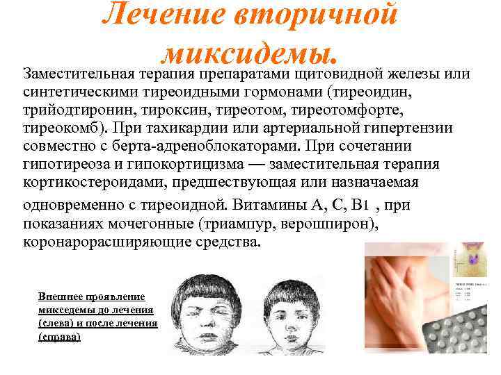 Лечение вторичной миксидемы. Заместительная терапия препаратами щитовидной железы или синтетическими тиреоидными гормонами (тиреоидин, трийодтиронин,
