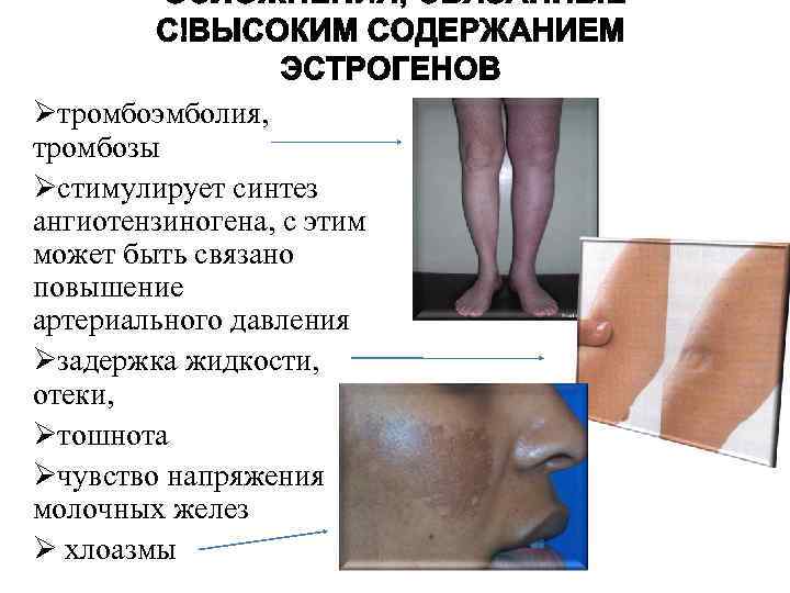 Øтромбоэмболия, тромбозы Øстимулирует синтез ангиотензиногена, с этим может быть связано повышение артериального давления Øзадержка