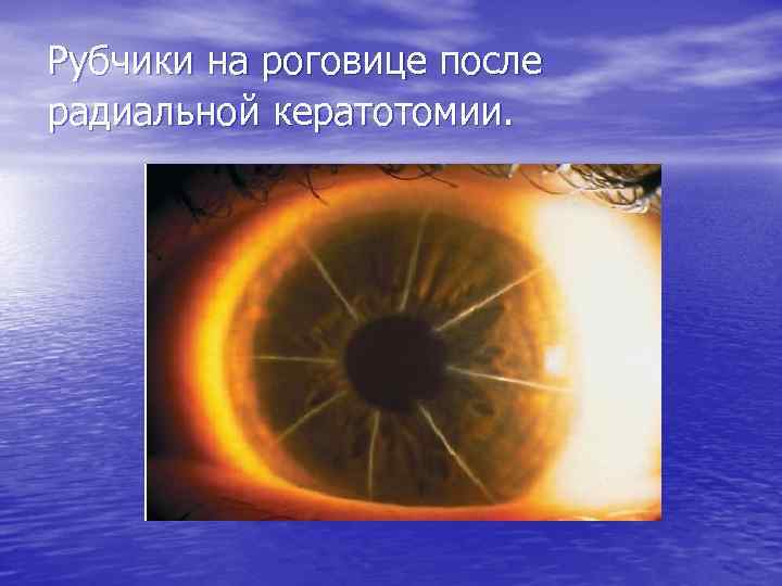 Рубчики на роговице после радиальной кератотомии. 