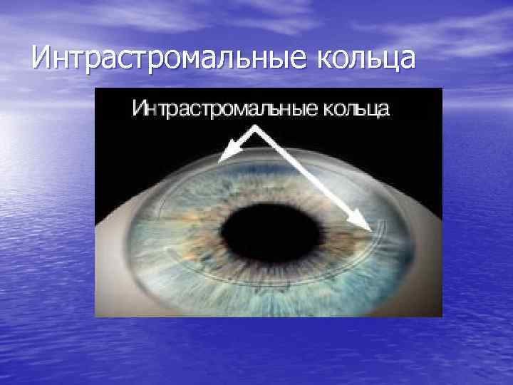 Интрастромальные кольца 