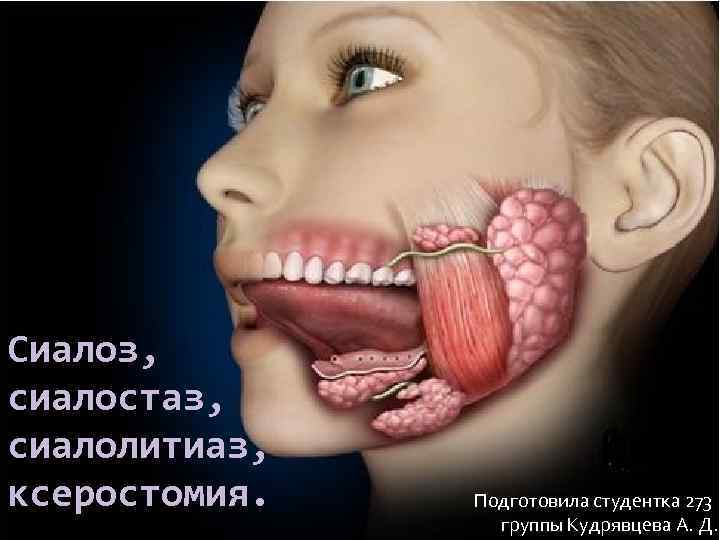Сиалоз, сиалостаз, сиалолитиаз, ксеростомия. Подготовила студентка 273 группы Кудрявцева А. Д. 