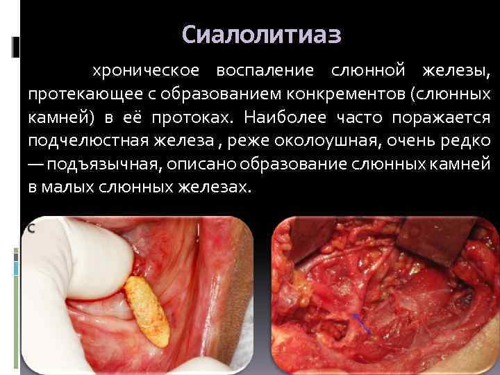 Сиалолитиаз хроническое воспаление слюнной железы, протекающее с образованием конкрементов (слюнных камней) в её протоках.