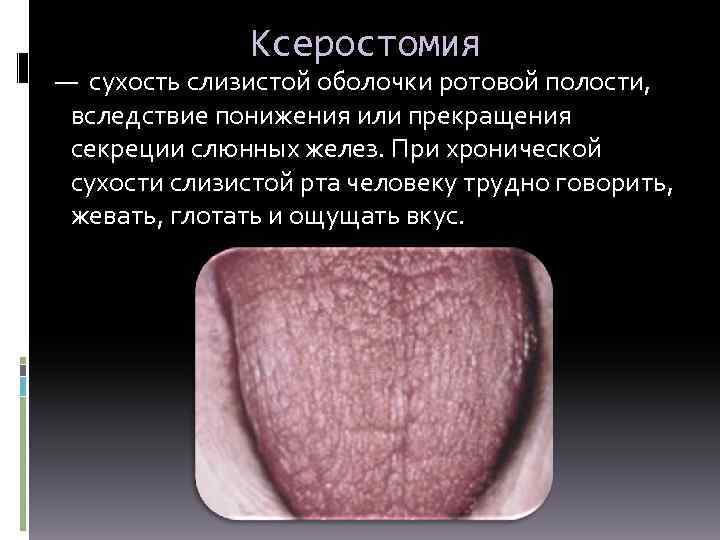 Ксеростомия — сухость слизистой оболочки ротовой полости, вследствие понижения или прекращения секреции слюнных желез.