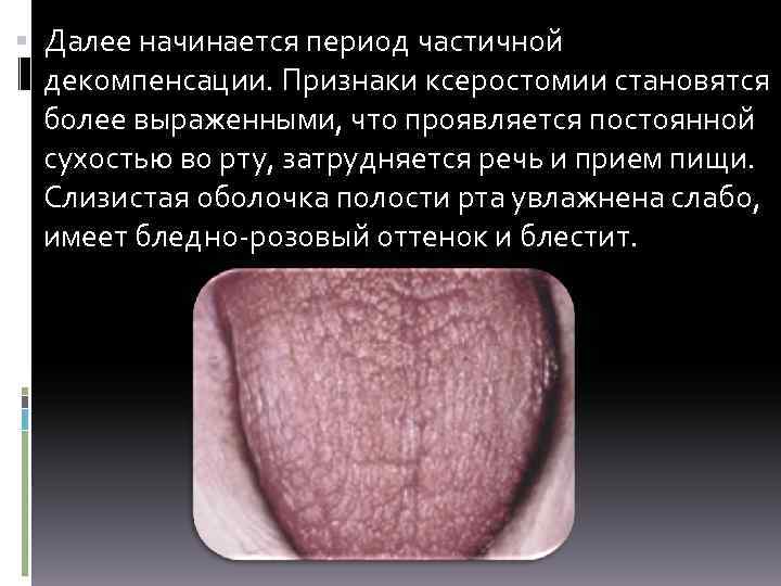 Далее начинается период частичной декомпенсации. Признаки ксеростомии становятся более выраженными, что проявляется постоянной