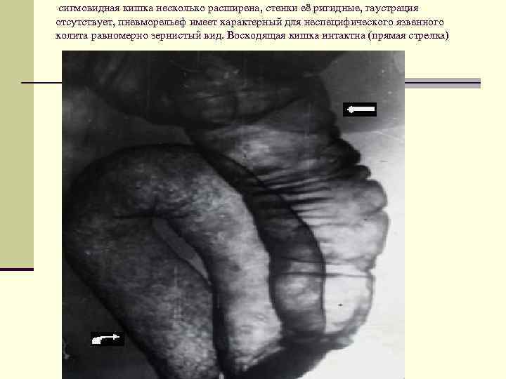  сигмовидная кишка несколько расширена, стенки её ригидные, гаустрация отсутствует, пневморельеф имеет характерный для