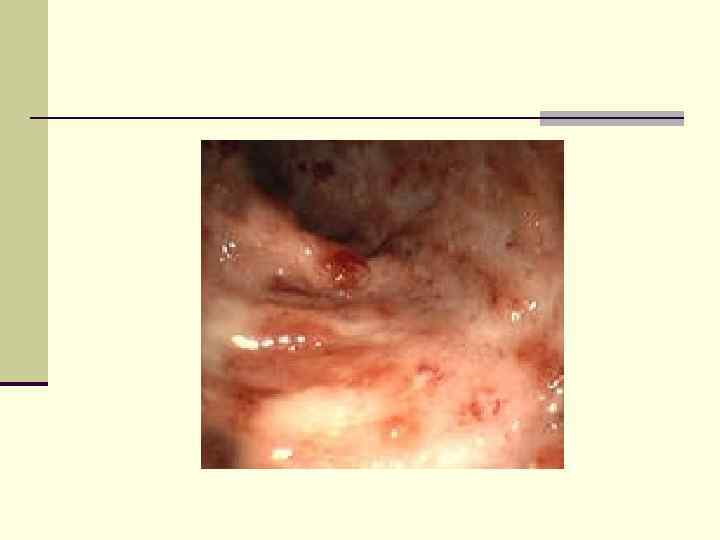 Слизистая оболочка толстой кишки при ЯК (псевдополипы) 