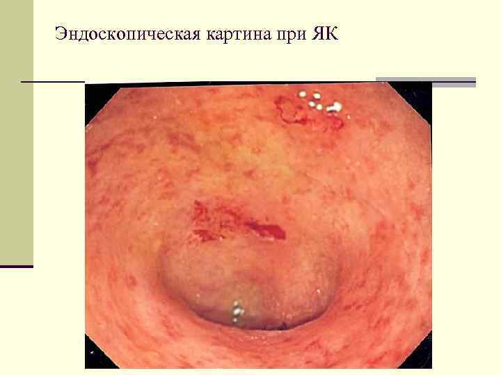 диагностика n Общеклинические обследования, в анализе крови анемия, высокая СОЭ, тромбоцитоз, снижение альбуминов сыворотки