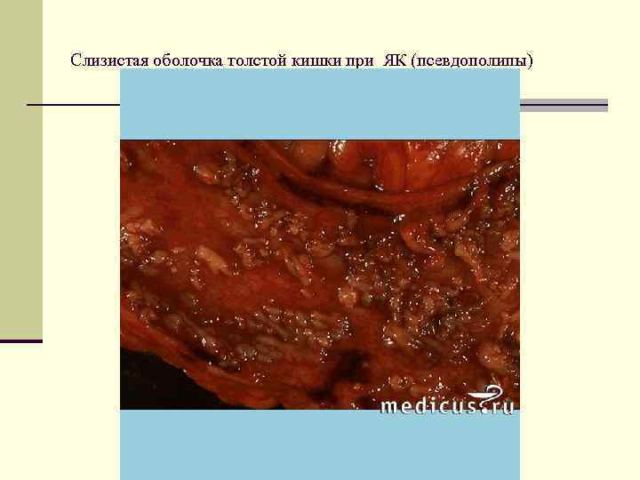  лечение n Медикаментозная терапия n Системные ГКС ( в течение месяца) - Преднизолон