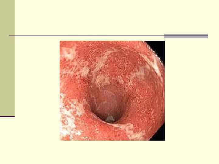 Клиника n Диарея, боли в животе, падение массы тела n Лихорадка, анорексия, слабость, повышенная