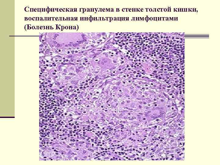 Клиника n При тонкокишечной локализации образуются афтозные язвы, трудно поддающиеся заживлению. n При