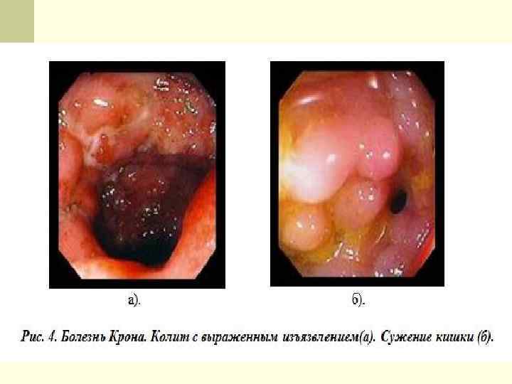 n Медикаментозная терапия n Системные ГКС ( в течение месяца) - Преднизолон 20 мг