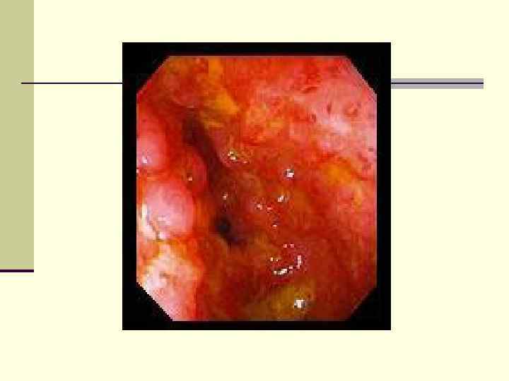 n При тяжелой форме n Госпитализация n Осмотр хирурга – проктолога (ежедневно) n Проведение