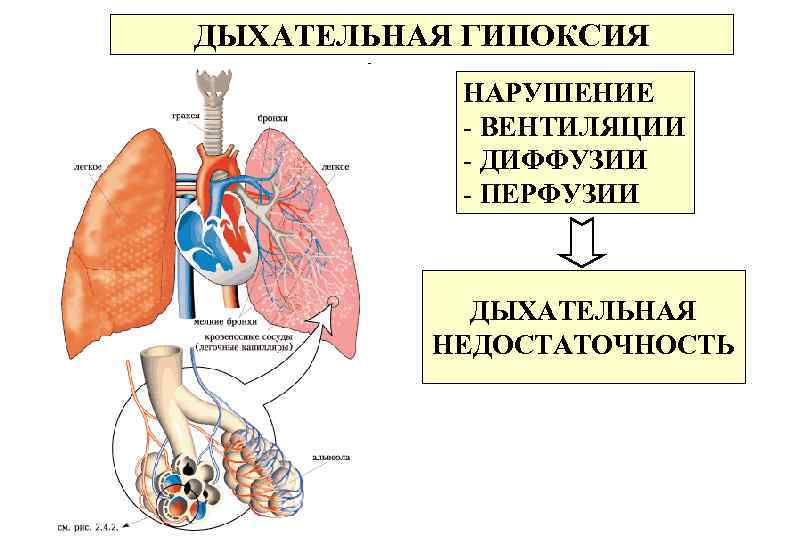 ДЫХАТЕЛЬНАЯ ГИПОКСИЯ НАРУШЕНИЕ - ВЕНТИЛЯЦИИ - ДИФФУЗИИ - ПЕРФУЗИИ ДЫХАТЕЛЬНАЯ НЕДОСТАТОЧНОСТЬ 
