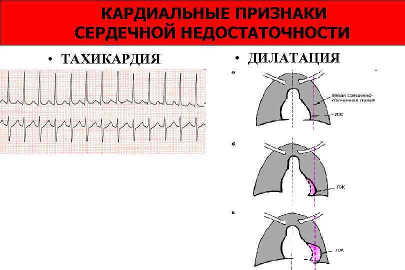 КАРДИАЛЬНЫЕ ПРИЗНАКИ СЕРДЕЧНОЙ НЕДОСТАТОЧНОСТИ • ТАХИКАРДИЯ • ДИЛАТАЦИЯ 