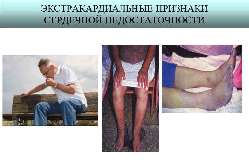ЭКСТРАКАРДИАЛЬНЫЕ ПРИЗНАКИ СЕРДЕЧНОЙ НЕДОСТАТОЧНОСТИ 
