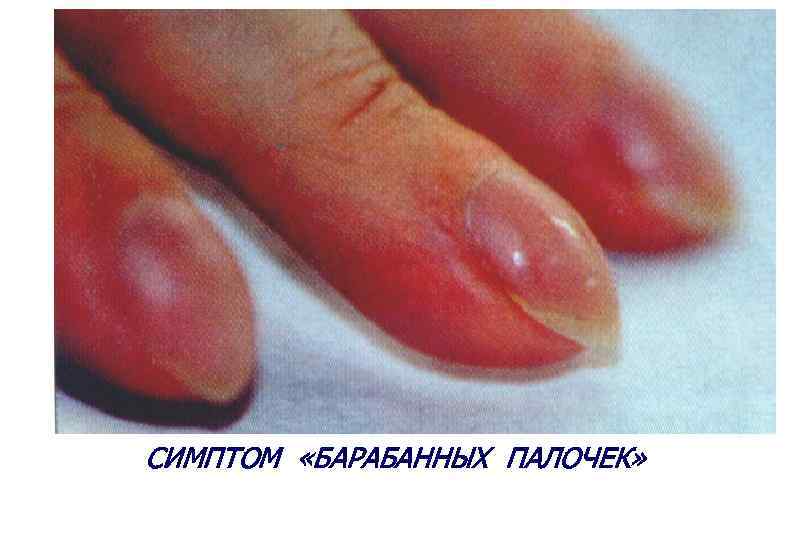 СИМПТОМ «БАРАБАННЫХ ПАЛОЧЕК» 