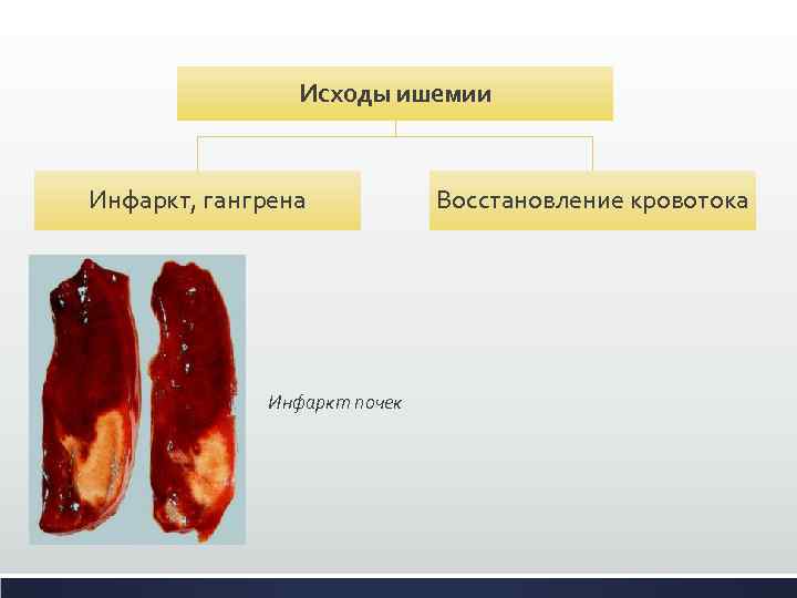 Исходы ишемии Инфаркт, гангрена Инфаркт почек Восстановление кровотока 