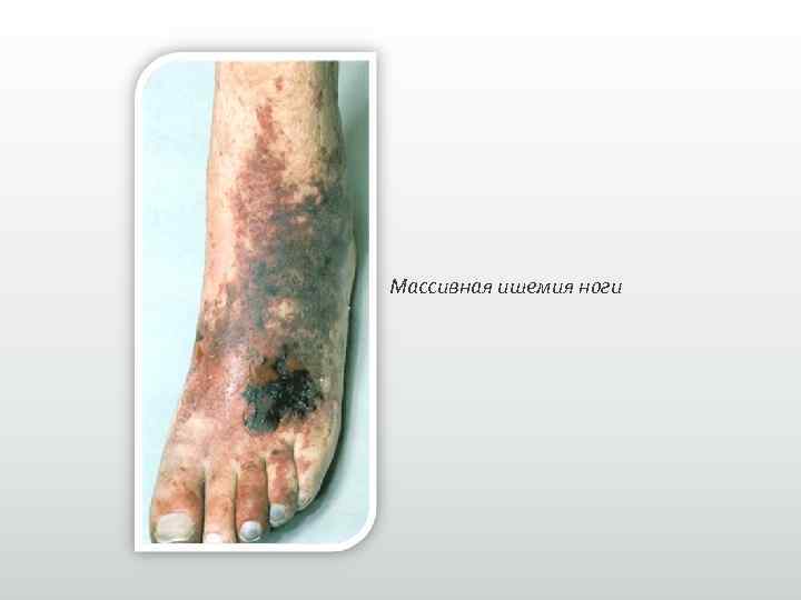 Массивная ишемия ноги 