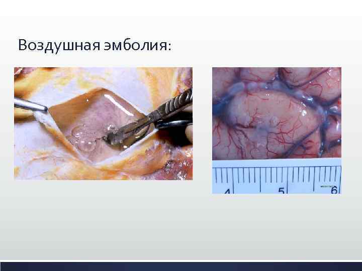 Воздушная эмболия: 