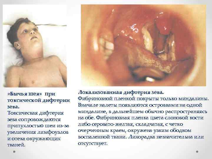  «Бычья шея» при токсической дифтерии зева. Токсическая дифтерия зева сопровождаются припухлостью шеи из-за