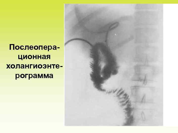 Послеоперационная холангиоэнтерограмма 
