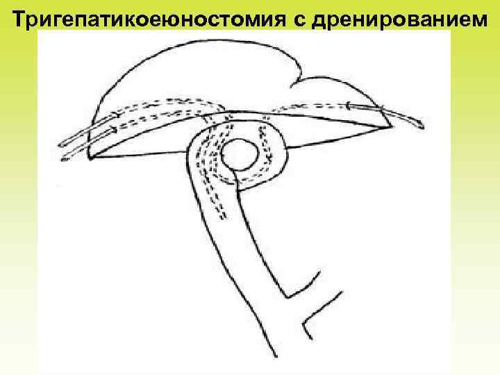 Тригепатикоеюностомия с дренированием 