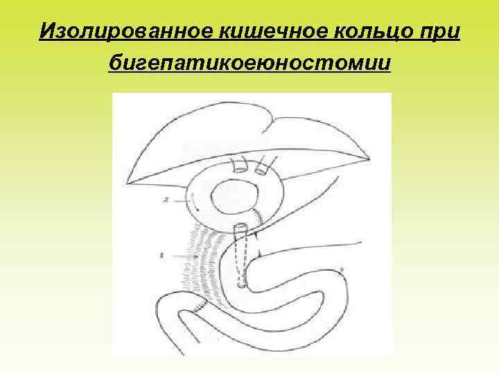 Изолированное кишечное кольцо при бигепатикоеюностомии 