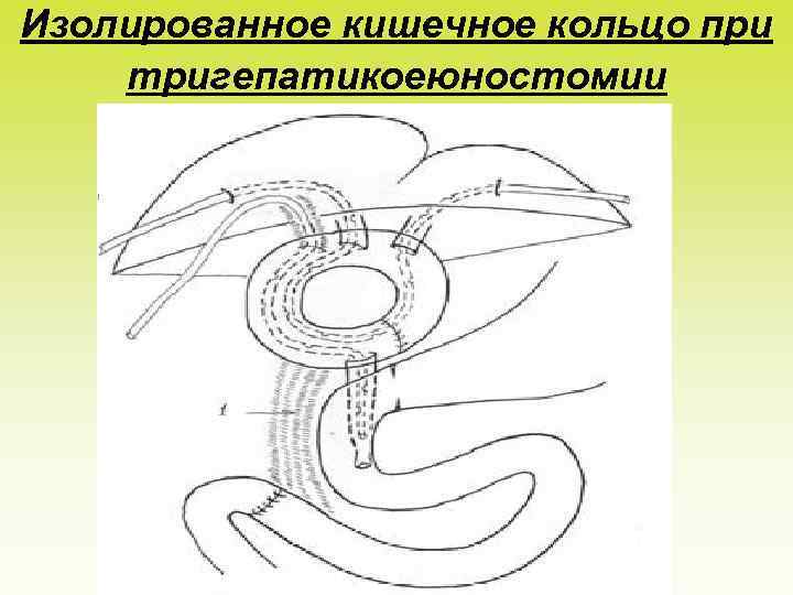 Изолированное кишечное кольцо при тригепатикоеюностомии 