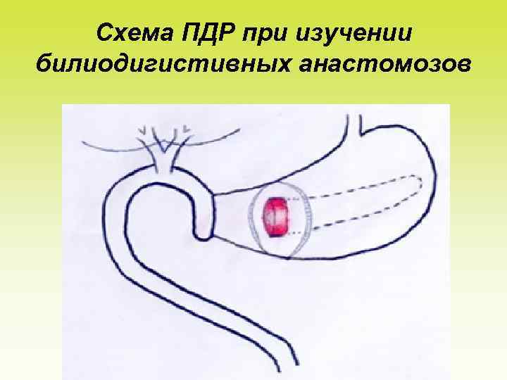 Схема ПДР при изучении билиодигистивных анастомозов 