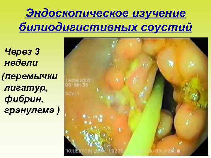 Эндоскопическое изучение билиодигистивных соустий Через 3 недели (перемычки лигатур, фибрин, гранулема ) 