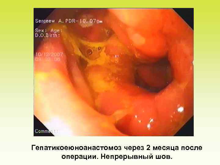 Гепатикоеюноанастомоз через 2 месяца после операции. Непрерывный шов. 