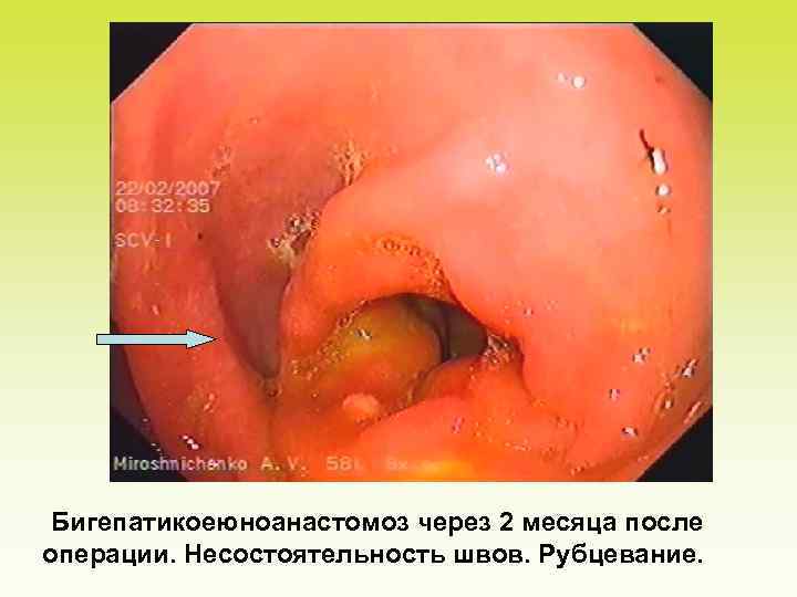Бигепатикоеюноанастомоз через 2 месяца после операции. Несостоятельность швов. Рубцевание. 