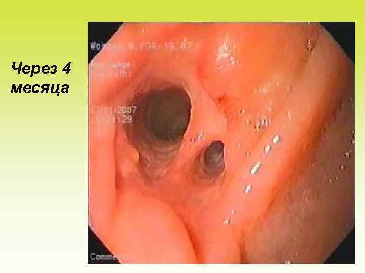 Через 4 месяца 