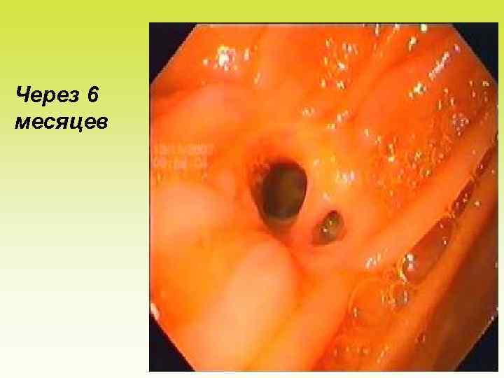 Через 6 месяцев 