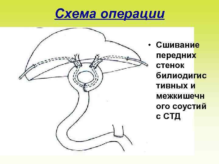 Схема операции