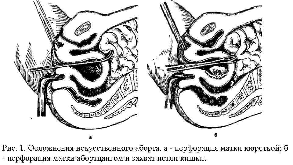 Рис. 1. Осложнения искусственного аборта. а - перфорация матки кюреткой; б - перфорация матки