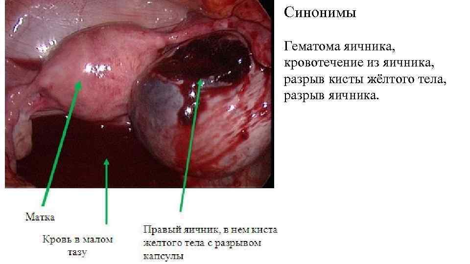 Синонимы Гематома яичника, кровотечение из яичника, разрыв кисты жёлтого тела, разрыв яичника. 