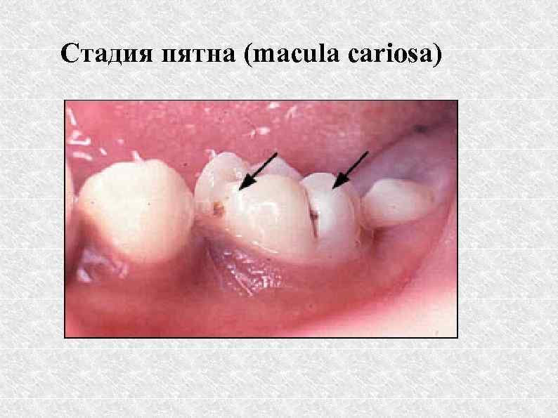 Стадия пятна (macula cariosa) 